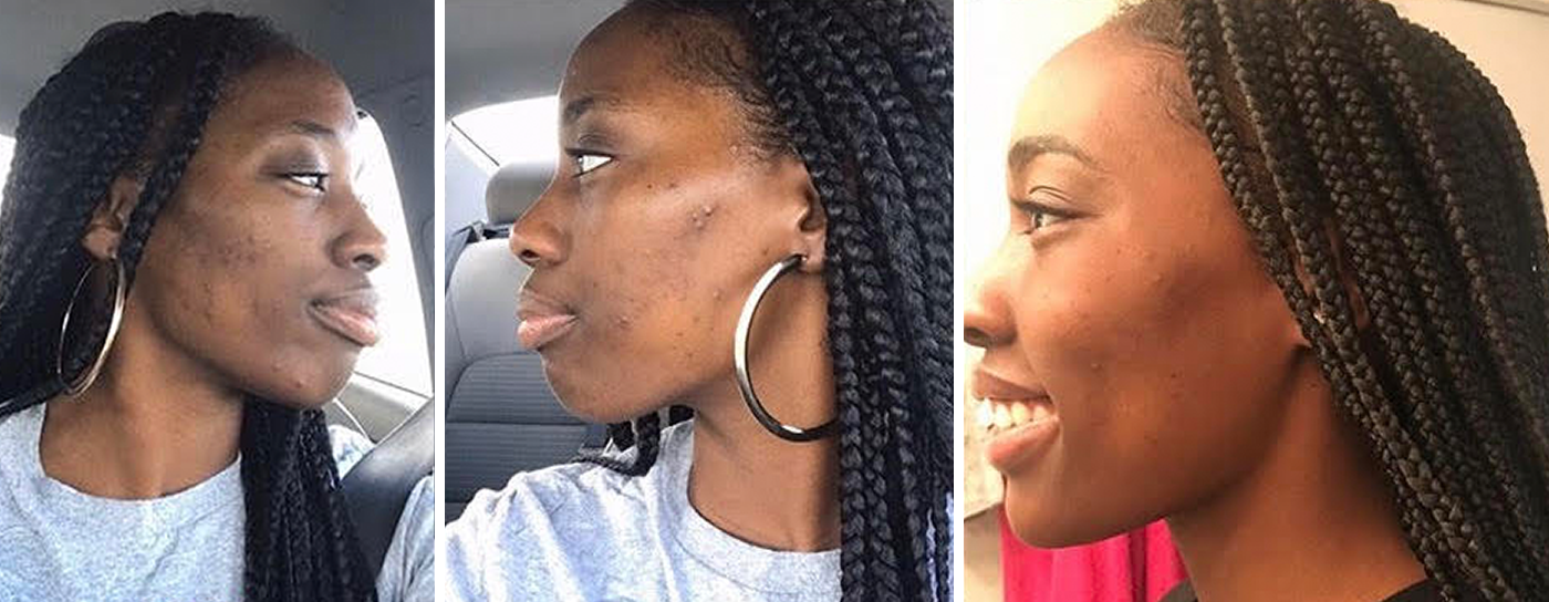 Skin Transformation Story: Kaedi Bowers