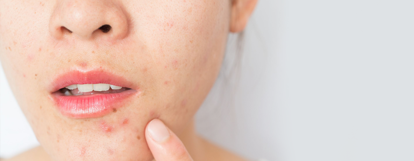 The Truth About Hormones & Skincare